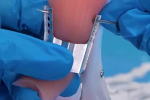 運(yùn)動(dòng)員們的跟腱都是怎么修復(fù)的？這么看起來(lái)真的太辛苦了